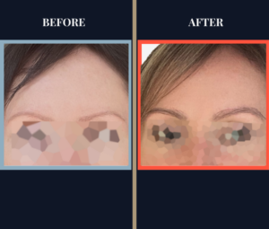 EYEBROW GRAFT HAIR TRANSPLANT BEFORE AND AFTER RESULTS