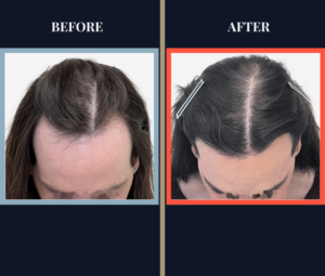 2000 GRAFT HAIR TRANSPLANT BEFORE AND AFTER RESULTS