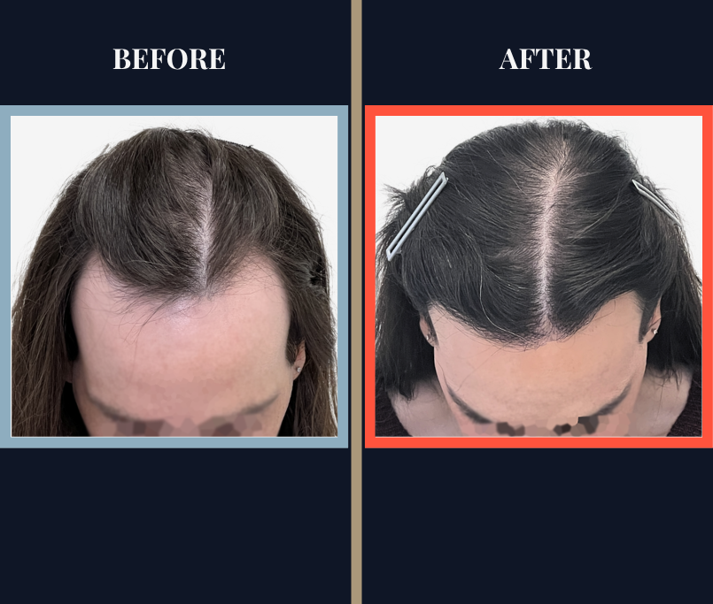 2000 GRAFT HAIR TRANSPLANT BEFORE AND AFTER RESULTS
