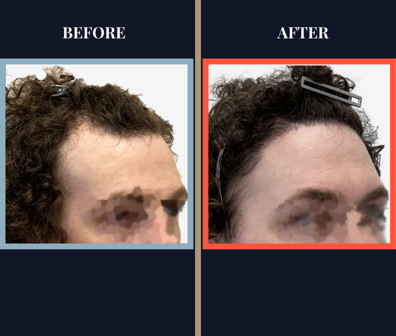 2229 GRAFT HAIR TRANSPLANT BEFORE AND AFTER RESULTS