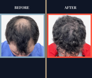 2023 GRAFT HAIR TRANSPLANT BEFORE AND AFTER RESULTS