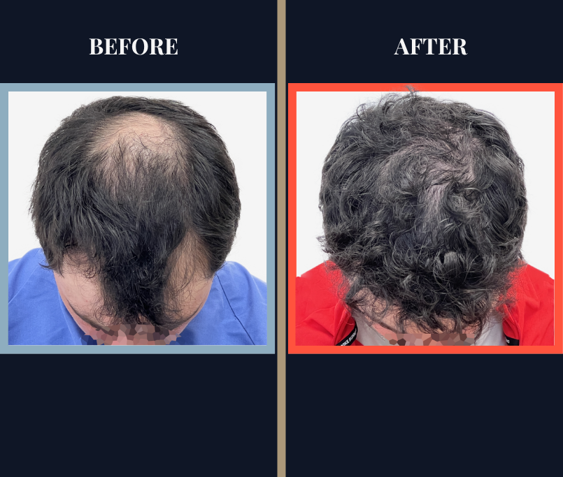 2023 GRAFT HAIR TRANSPLANT BEFORE AND AFTER RESULTS