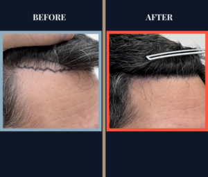 NO SHAVE HAIR TRANSPLANT RESULTS