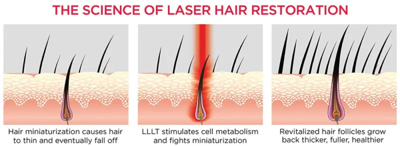 Biolight - The Science Of Laser Light Hair Restoration Biolight - The Science Of Laser Light Hair Restoration