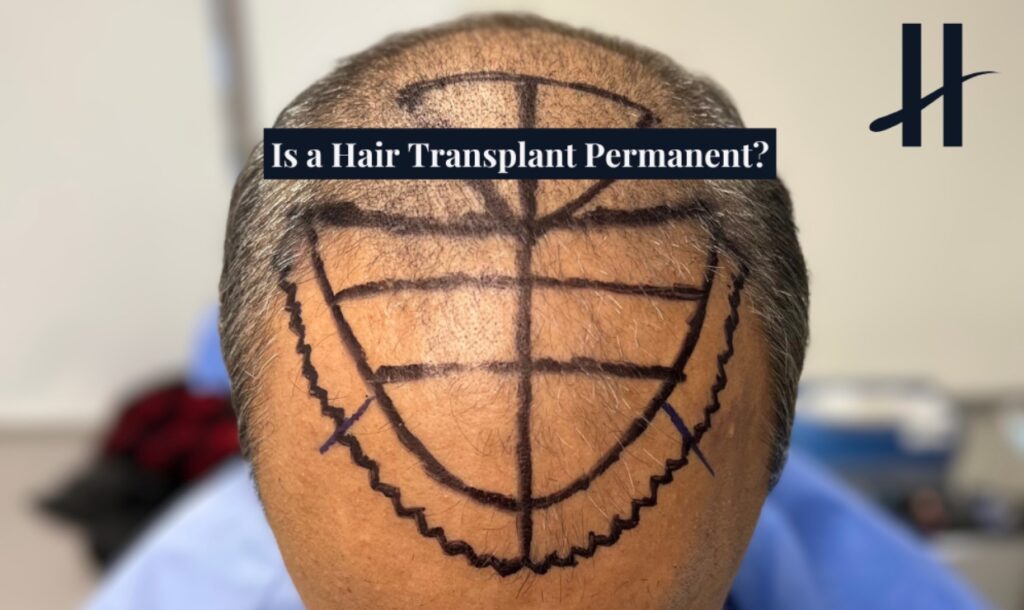 Hair Transplant Permanent - THTS