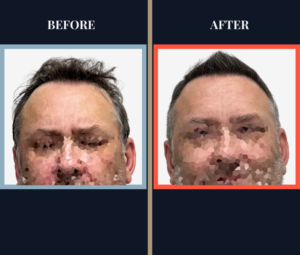 1526 Graft FUE Before and After