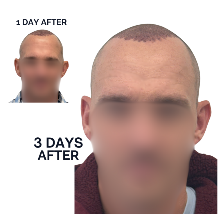 Post-Op Recovery Timeline Photo Day 1 and 3