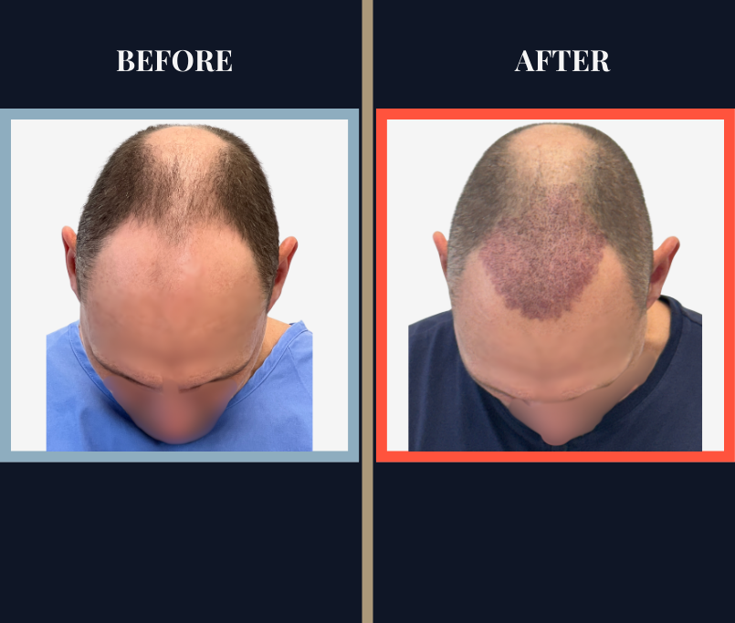 Post-Op Recovery Timeline 2277 G FUE
