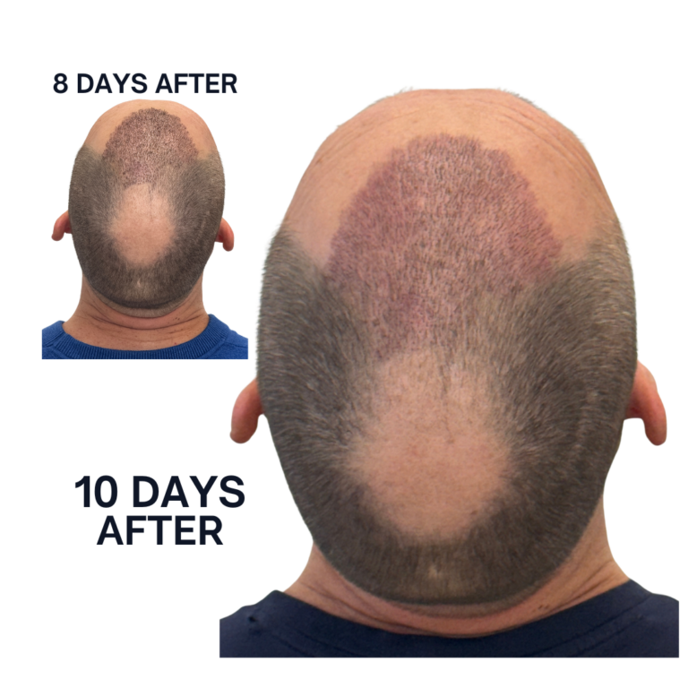 Post-Op Recovery Timeline Photo Day 8 and 10