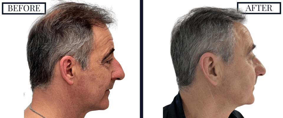 2050 FUE GRAFT HAIR TRANSPLANT