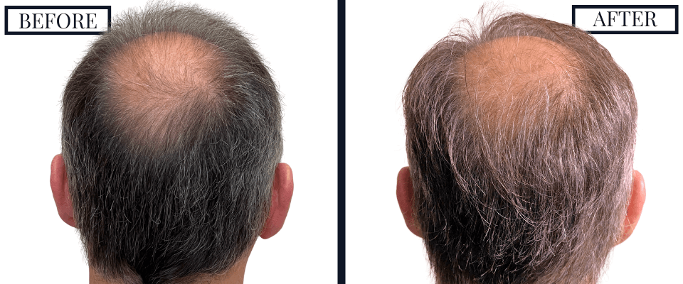 2562 FUE Hair Transplant