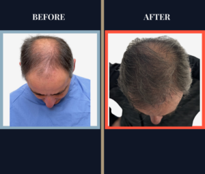 FUE hair transplant - 2 surgeries