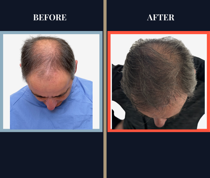 FUE hair transplant - 2 surgeries