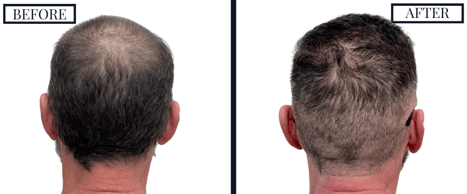2420 Graft FUE Hair Transplant Before and After