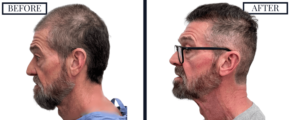 2420 Graft FUE Hair Transplant Before and After