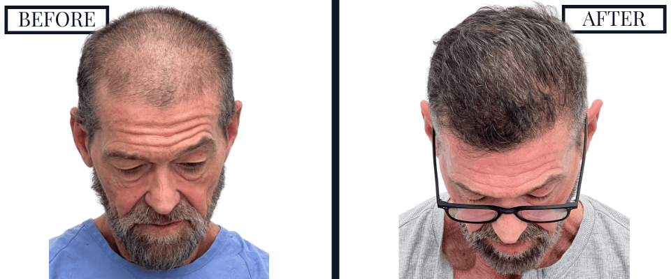 2420 Graft FUE Hair Transplant Before and After