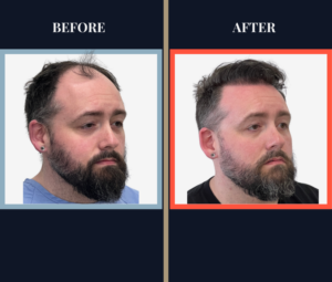 2716 graft FUE - 1 year post-op before and after