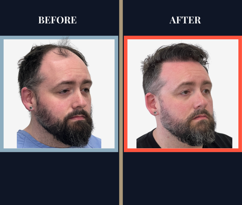 2716 graft FUE - 1 year post-op before and after