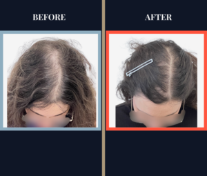 PRP Treatment