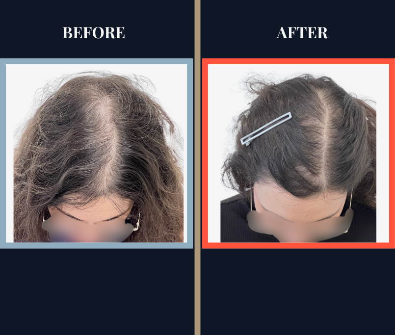 PRP Treatment