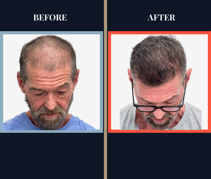2420 Graft FUE Hair Transplant Before and After