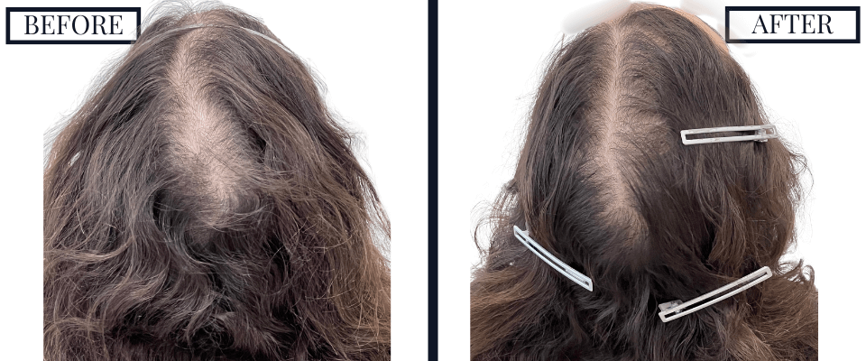 PRP Treatment Photos