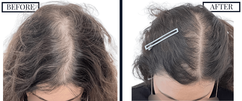 PRP Treatment Photos