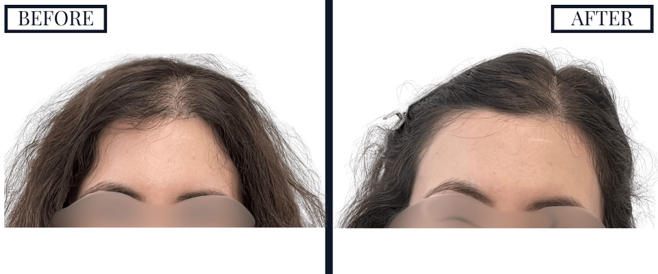 PRP Treatment Photos