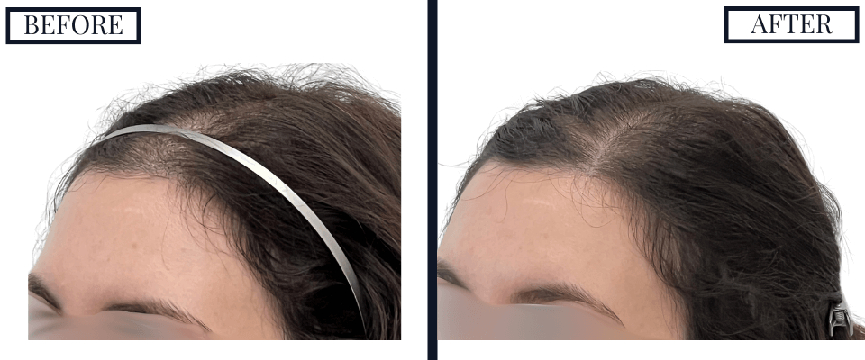 PRP Treatment Photos