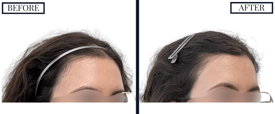 PRP Treatment Photos