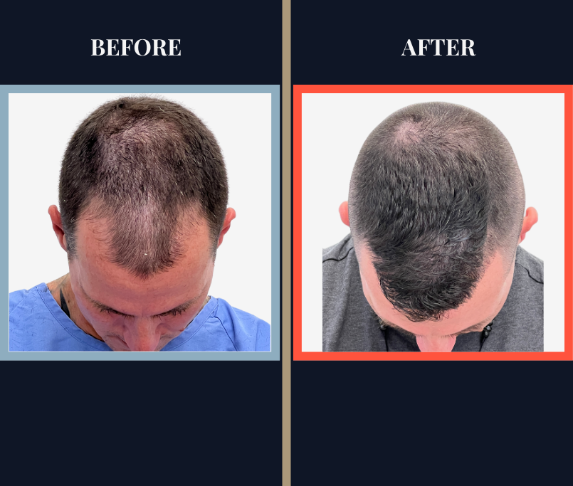 1501 Graft FUE BEFORE AND AFTER