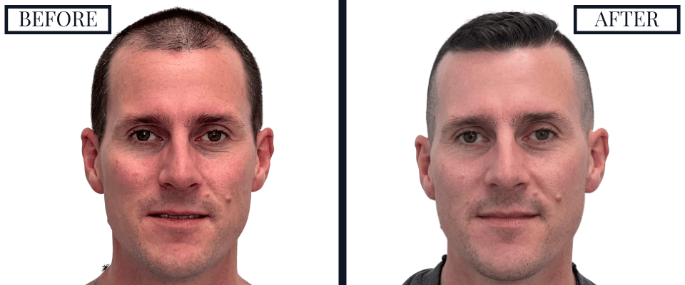 1501 Graft FUE BEFORE AND AFTER