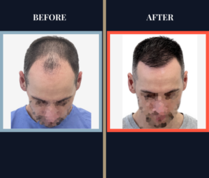 1800 Graft Hair Transplant FUE