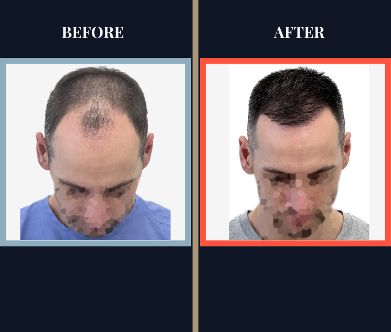 1800 Graft Hair Transplant FUE