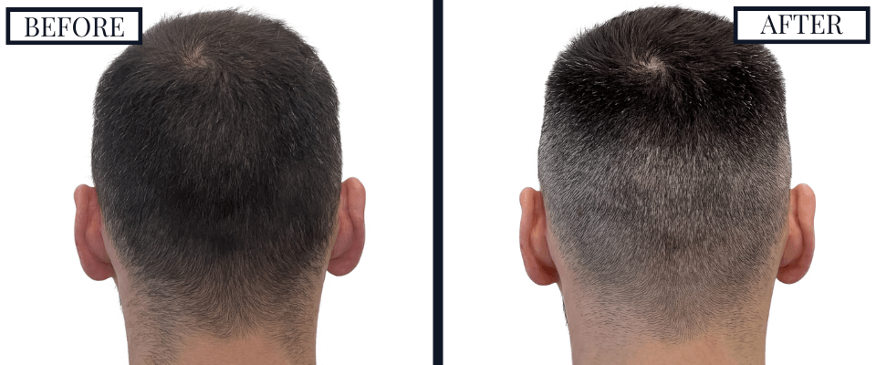 1800 Graft FUE Hair Transplant