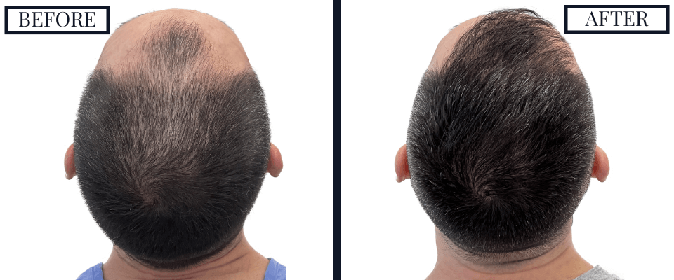 1800 Graft FUE Hair Transplant