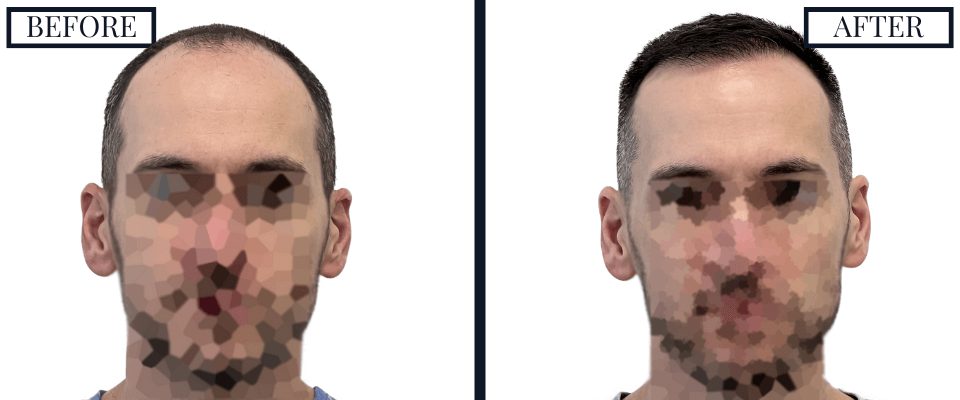1800 Graft FUE Hair Transplant
