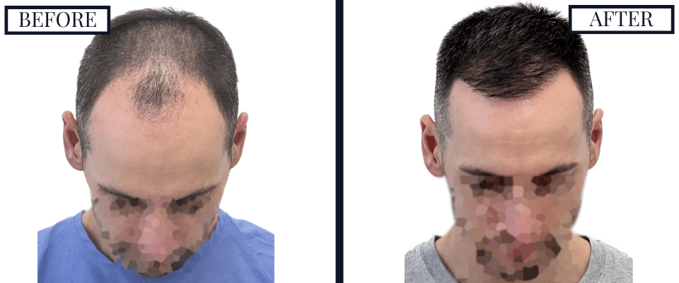 1800 Graft FUE Hair Transplant