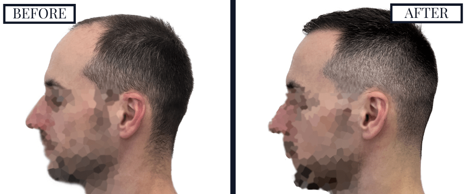 1800 Graft FUE Hair Transplant