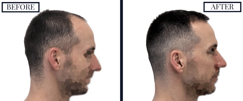 1800 Graft FUE Hair Transplant