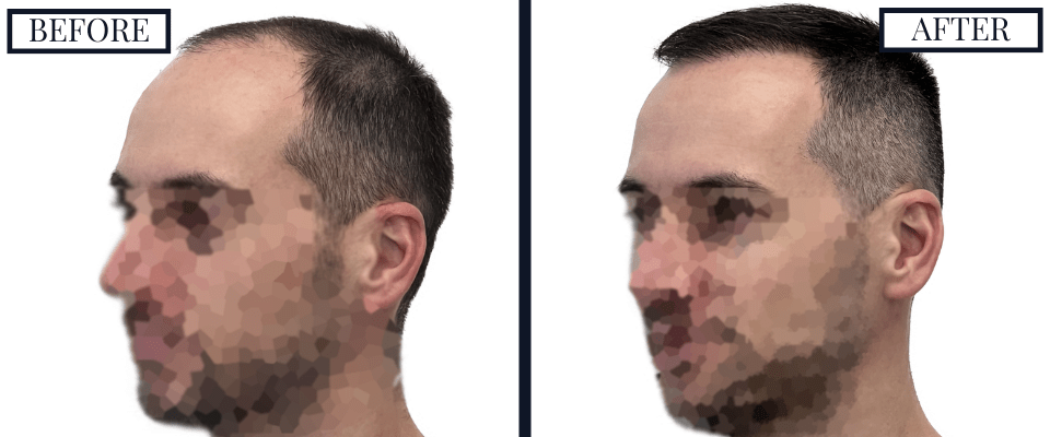 1800 Graft FUE Hair Transplant