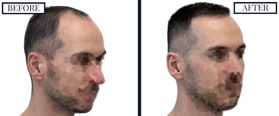 1800 Graft FUE Hair Transplant
