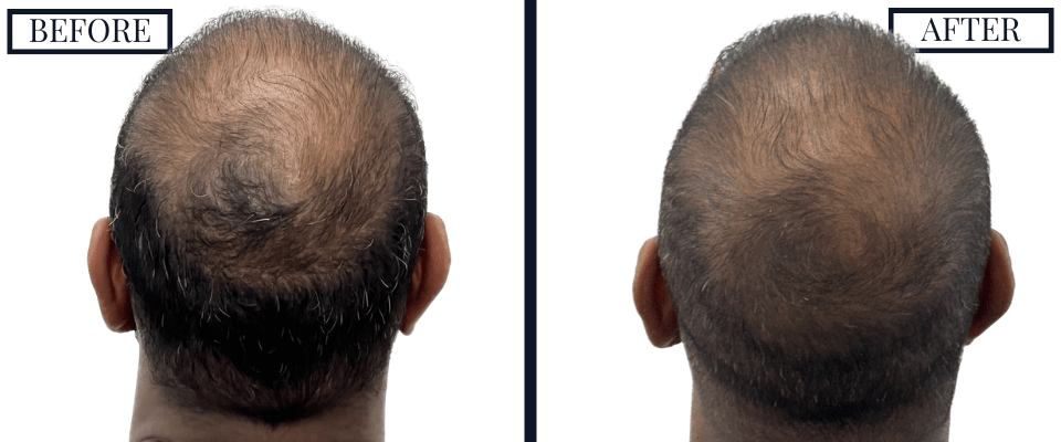 1516 Graft FUE Before and After Photo
