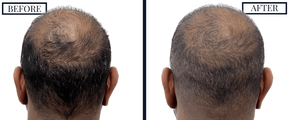 1516 Graft FUE Before and After Photo
