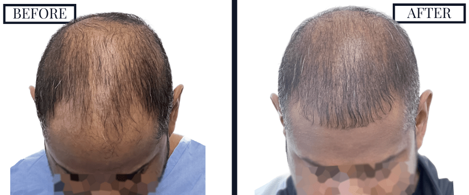 1516 Graft FUE Before and After Photo