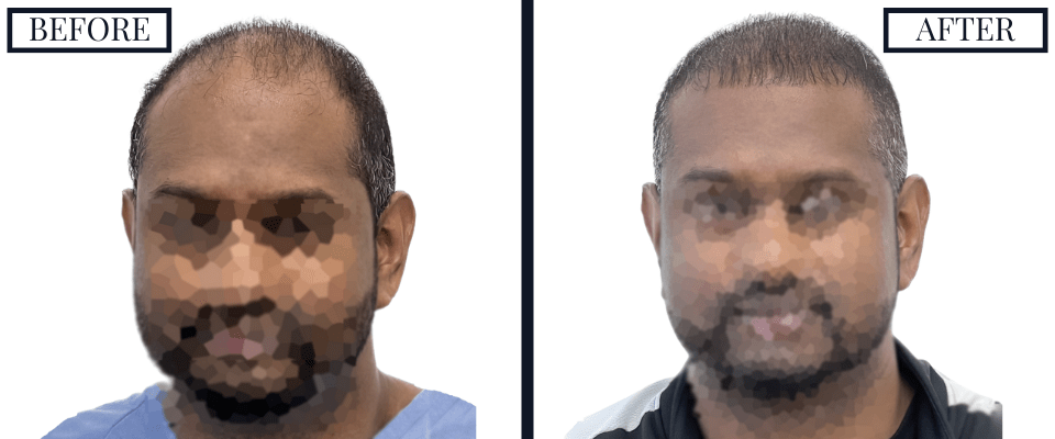 1516 Graft FUE Before and After Photo