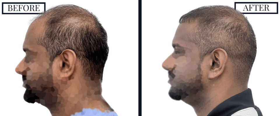 1516 Graft FUE Before and After Photo