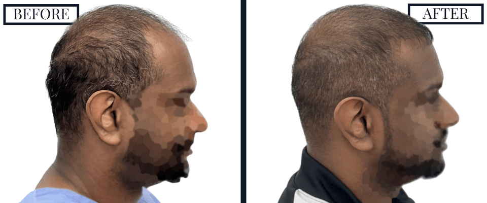 1516 Graft FUE Before and After Photo