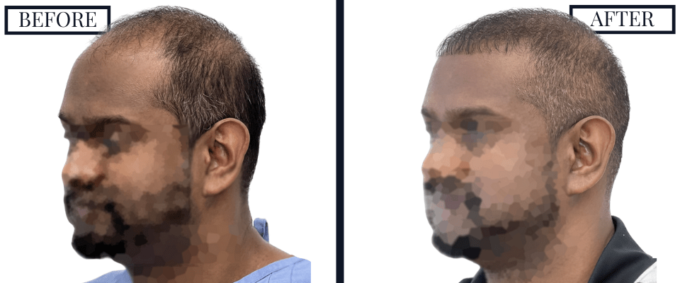 1516 Graft FUE Before and After Photo