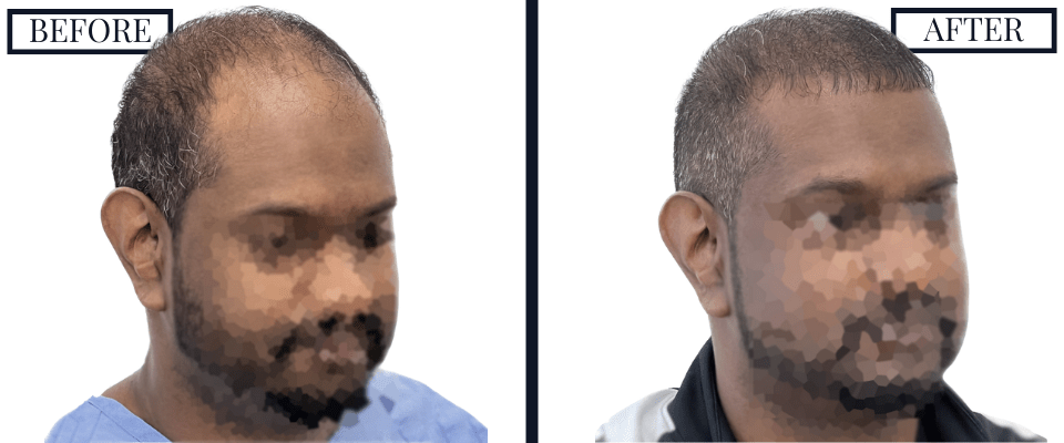 1516 Graft FUE Before and After Photo